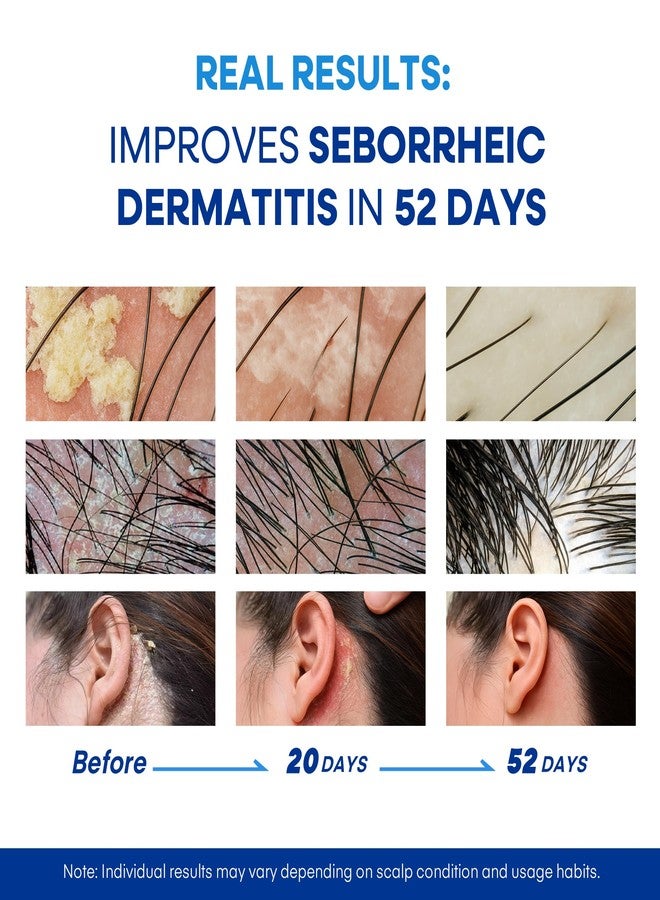 Hermon Medicated Shampoo for Scalp Seborrheic Dermatitis & Psoriasis: Plant-Based Formula Soothes Itch, Reduces Flakes, Supports Hair Health & Deep Cleansing Treatment for man and women 300ml/10.0fl oz - Image 3